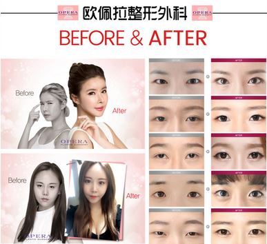 韩国欧佩拉整形外科，认为双眼皮手术容易是最大的误会